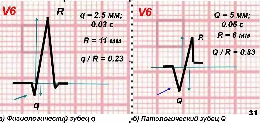 Изменение зубца q. Патологический зубец q на ЭКГ при инфаркте. Зубец q на ЭКГ при инфаркте. Зубец q v1 AVR. Патологический зубец q на ЭКГ при инфаркте миокарда.