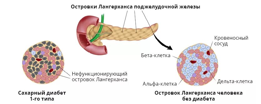 Разрушение бета клеток поджелудочной железы. Островки Лангерганса поджелудочной железы. Бета клетки островков Лангерганса. Сахарный диабет 1 типа поджелудочная железа. Пересадка поджелудочной при диабете