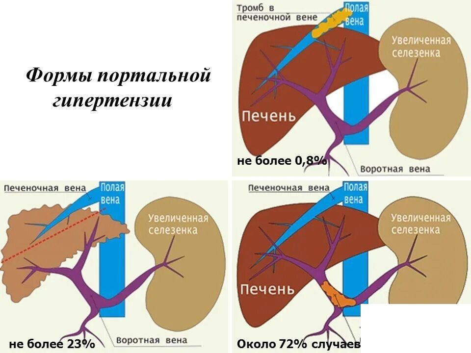 Портальная гипертензия это. Синдром портальной гипертензии. Синдром печеночной гипертензии. Методы исследования при портальной гипертензии. Портальная гипертензия это.