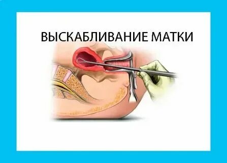 Беременность после чистки замершей беременности форум