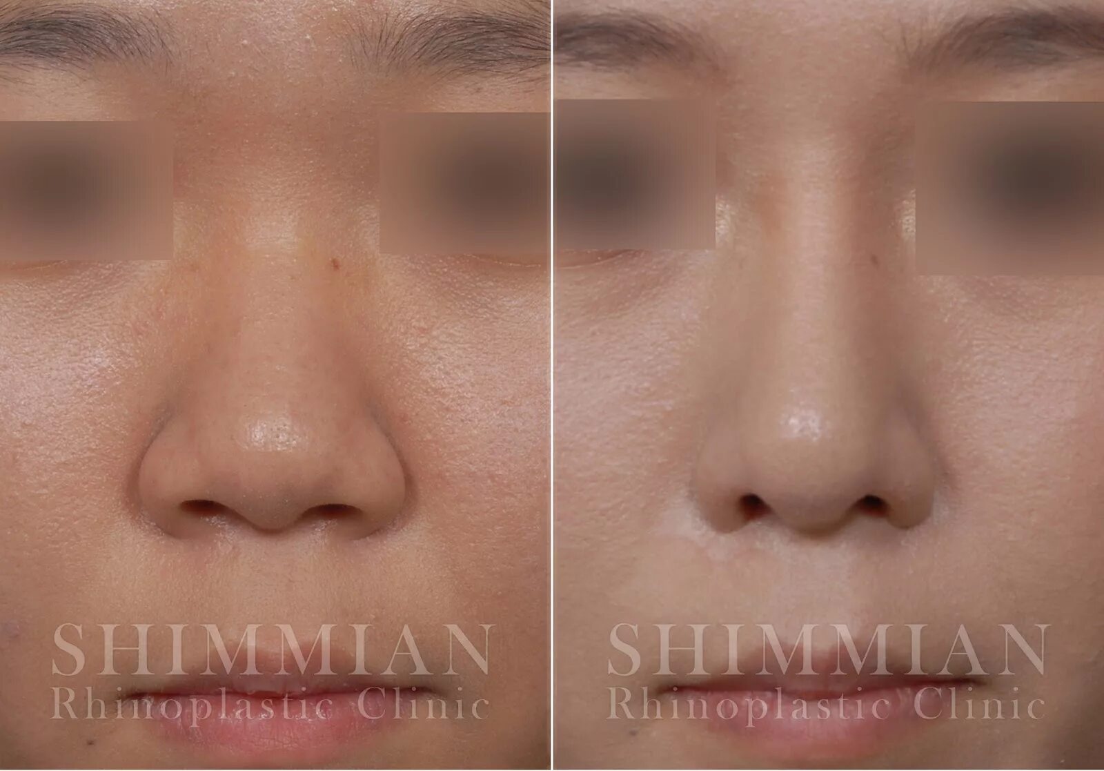 Новый нос от доктора Шихирмана. История Марины. Часть 1 Beauty Insider