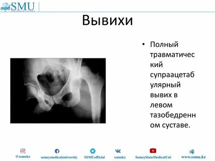 Диагностика вывихов