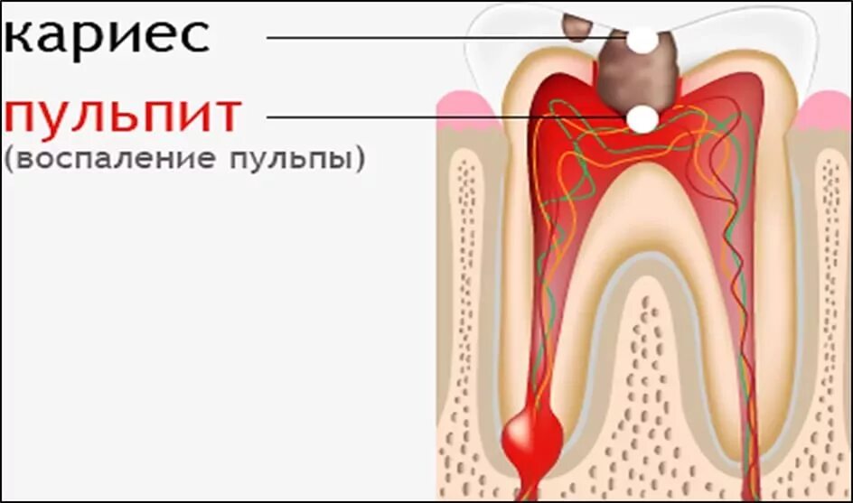 Как вылечить пульпит. Многокорневой пульпит. воспаление зуба пульпит. конкрементозный пульпит.