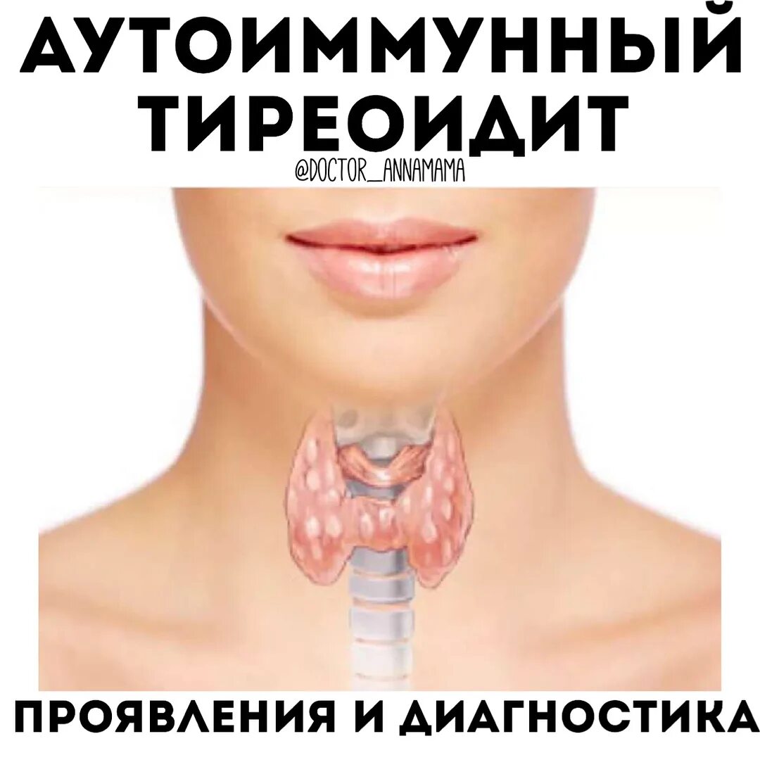 Аутоиммунный тиреоидит. Аутоиммунный тиреоидит щитовидной железы что это такое. Тиреоидит щитовидной железы что это такое. Хронический аутоиммунный тиреоидит. Диффузный аутоиммунном тиреоидите