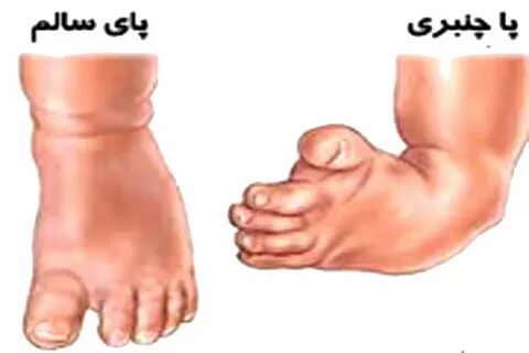 Club foot
