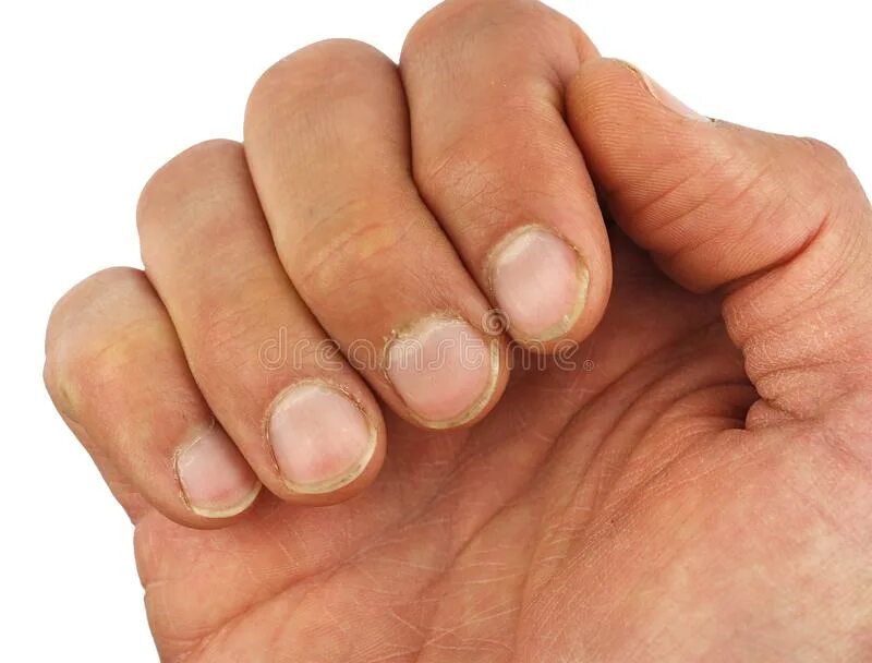 Ногти на больших пальцев мужчин. Мужские ногти неопрятные.