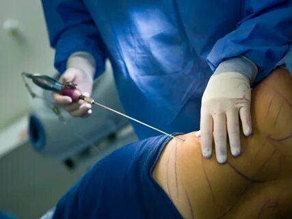 Expert Gynecomastia Treatment Riyadh