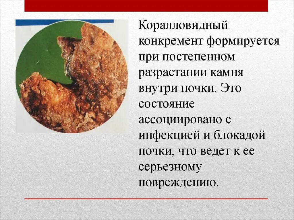 Конкремент латынь. Коралловидный камень к4 почки. Мочекаменная болезнь коралловидные камни. Коралловидный камень симптомы. Коралловидный конкремент.