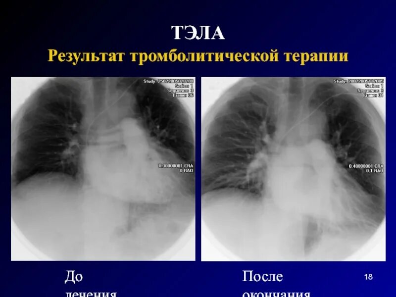 Тромболитическая терапия при тэла. Тромболитическая терапия при тэла. Тропониновый тест при тэла. Тлт противопоказания при тэла. Тромболитическая терапия при тэла.