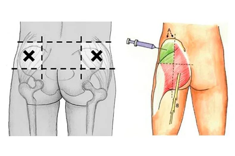 Болят ягодицы от уколов. Схема внутримышечной инъекции в ягодицу. Как правильно сделать укол внутримышечно. Как поставить укол внутримышечно. Место укола внутримышечно в ягодицу.