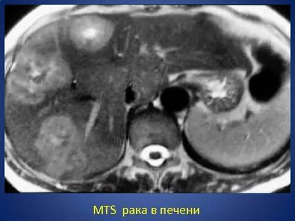 Mts печени