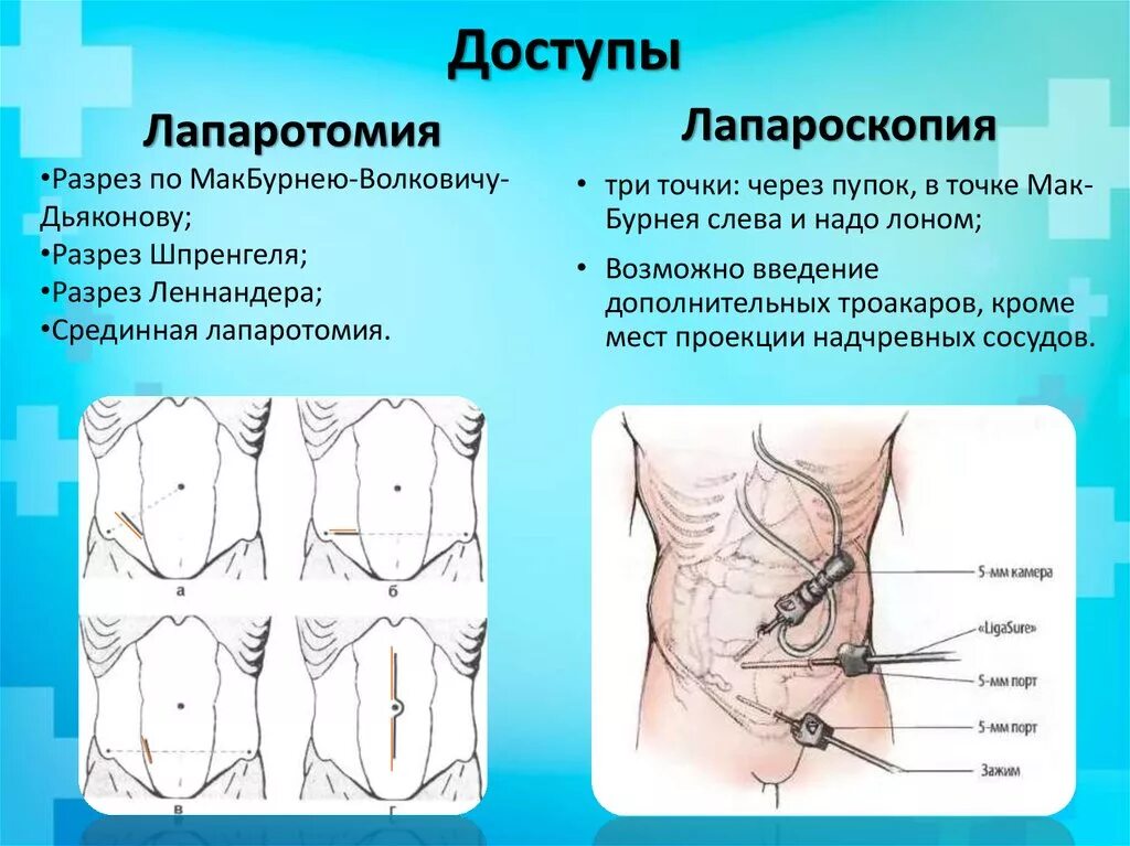 Лапаротомия доступом Волковича-Дьяконова. Аппендэктомия разрез Волковича-Дьяконова. Мак Бурнея Волковича Дьяконова. Разрез Мак Бурнея Волковича Дьяконова. Абдоминальная операция что это