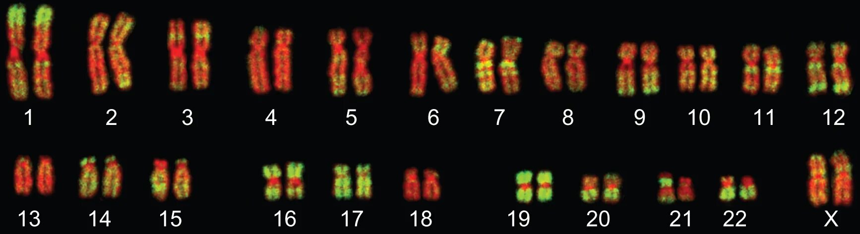 Изменение окраски хромосом. Нормальный кариотип человека 46 хромосом. Цитогенетический метод окрашивание хромосом. Хромосомы кариотип.