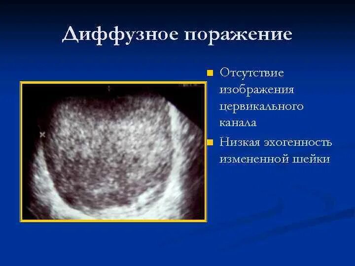 Эхогенность эндометрия в секреторную фазу. Шейка матки повышенной эхогенности. Кома диффузного поражения.