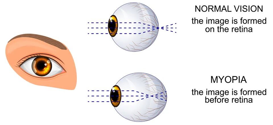 Глаз как переводится. Анизометропия глаза. Анизометропия и астигматизм. Vision eyesight разница. Eyesight, short Vision.