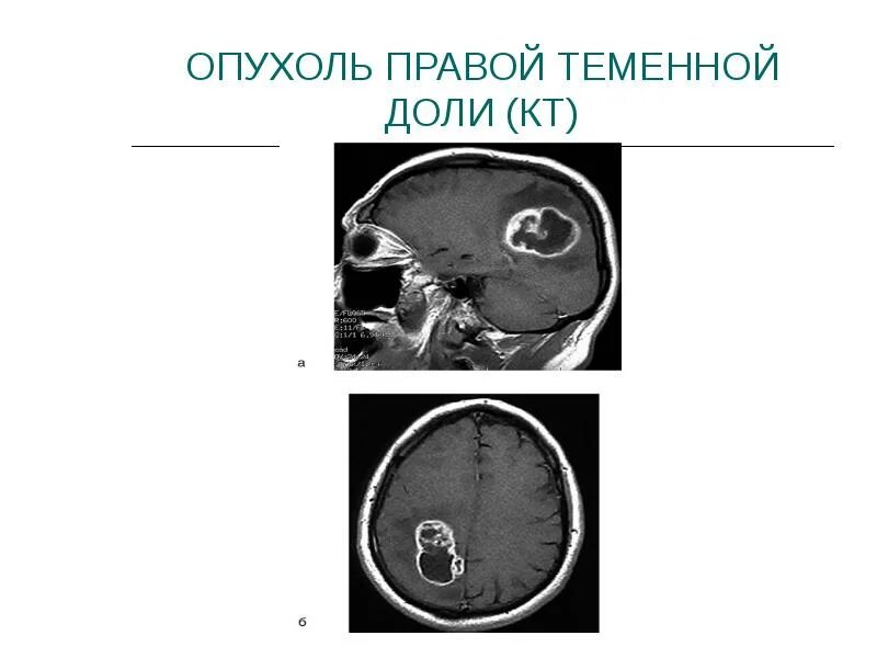 Опухоли теменной. Опухоль головного мозга на кт. Опухоль правой теменной доли. Опухоли теменной доли клиника.