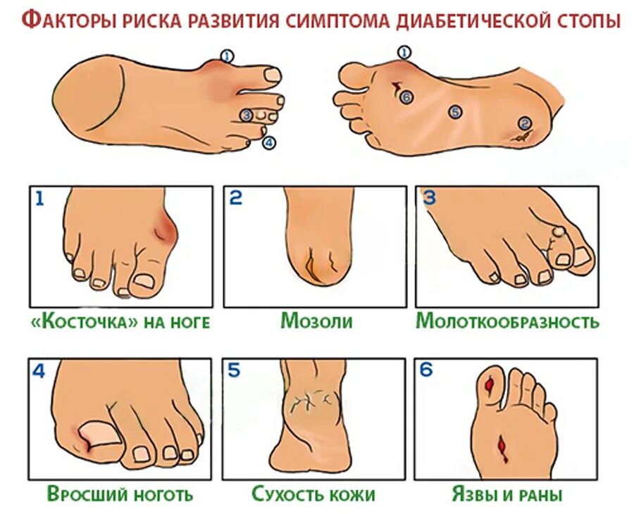 Язвы сахарный диабет лечение. Диабетическая стопа при сахарном диабете. Обработка диабетической стопы. Синдром диабетической стопы. Диабетическая стопа симптомы.