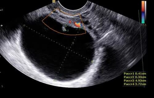 Фолликулярная киста яичника на УЗИ. Киста фолликул фолликулярная яичника. Киста на яичнике УЗИ У женщин. Эндометриоидная киста на УЗИ. Фолликулы 6 мм