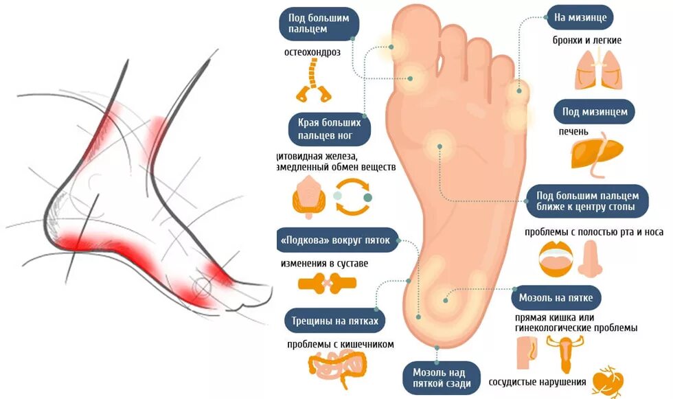 Почему болят ступни. Больные натоптыши на подошве. Больные точки натоптыши на стопе.