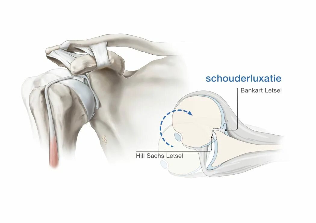 повреждения головки плечевой кости