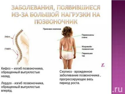 Физиологический изгиб позвоночника вперед