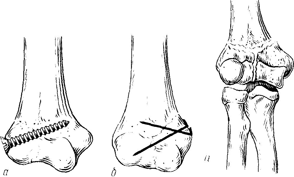 Т образный перелом мыщелка плечевой кости. Перелом мвщелка лучевой кости. Переломчрезмыщелковые плечевой кости. Перелом головки мыщелка плечевой кости.