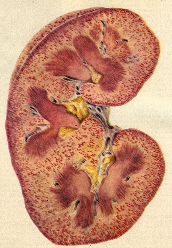 Острые почечные заболевания. Патанатомия гломерулонефрит патанатомия. Острый гломерулонефрит патанатомия патанатомия. Подострый гломерулонефрит мfкропрепарат. Острый гломерулонефрит макропрепарат.