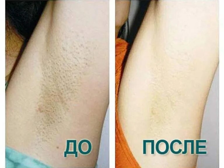 Шугаринг сама себе подмышки