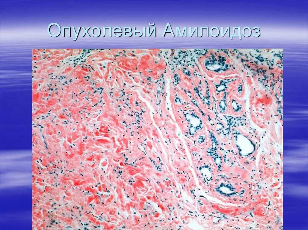 Мезенхимальные белковые. Стромально-сосудистые углеводные дистрофии. Стромально-сосудистая углеводная дистрофия гистология. Амилоидоз мезенхимальная дистрофия. Стромально-сосудистые углеводные дистрофии патологическая анатомия.
