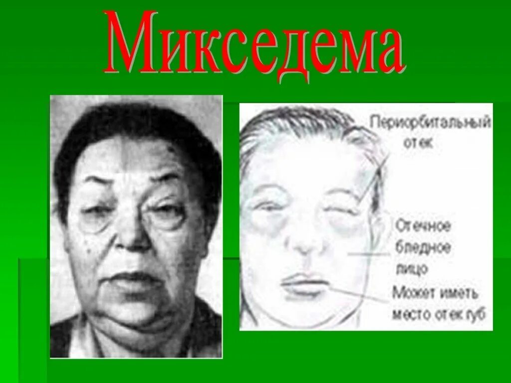 Мексидема. Муцинозный отек (микседема). Лицо больного микседемой.