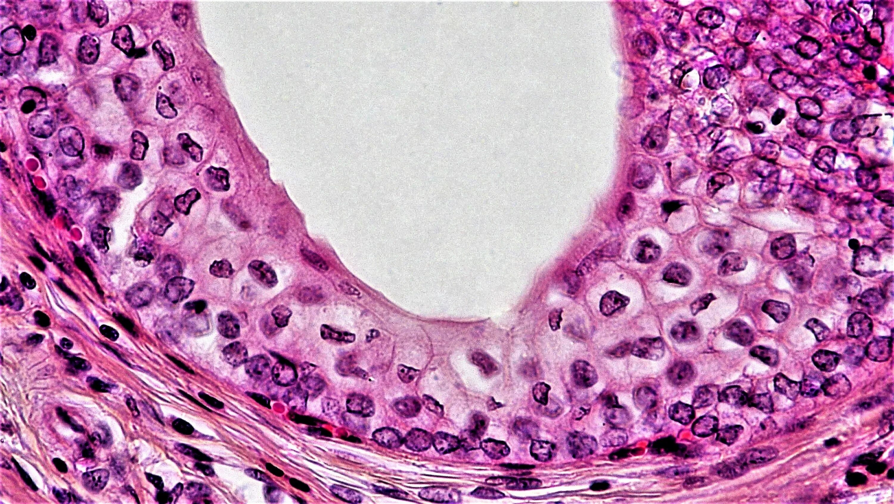 Хорионэпителиома матки микропрепарат. Доброкачественная опухоль эпителиальной ткани. Эпителиальные опухоли патологическая анатомия. Перстневидноклеточный(слизистый)рак желудка. Папиллома кожи микропрепарат.