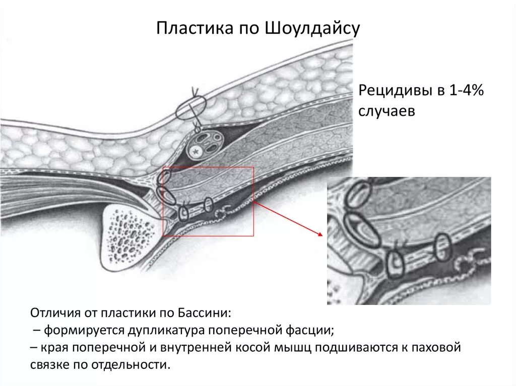 Какой наркоз при паховой грыже. Шолдайсу грыжесечение. пластика паховой грыжи по шоулдайс. паховая грыжа пластика по шолдайсу. шолдайс пластика грыжи.
