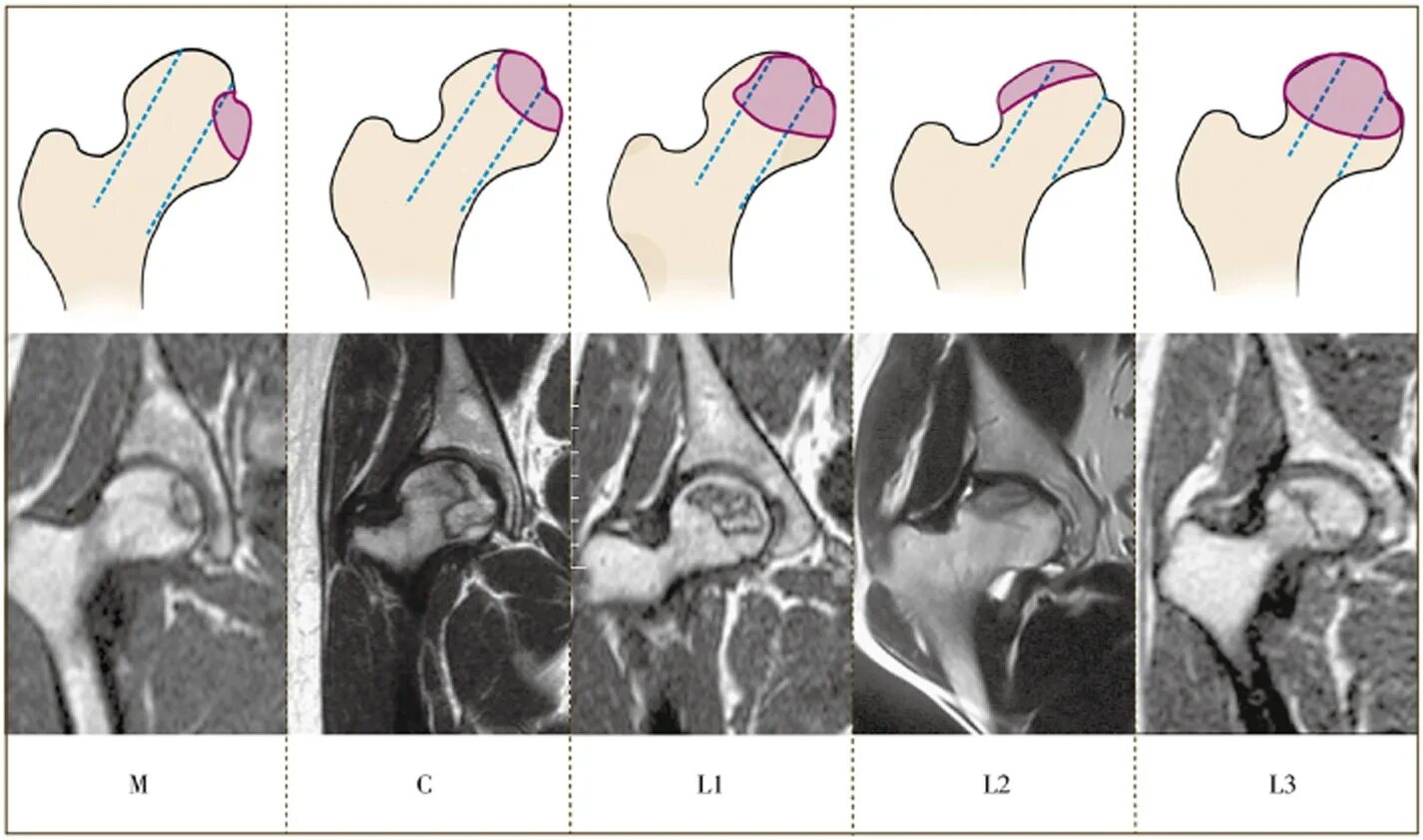 Асептический некроз стадии рентген. Асептический некроз головки бедренной кости кт. Стадии асептического некроза головки бедренной кости мрт. Степени асептического некроза головки бедренной кости на рентгене.