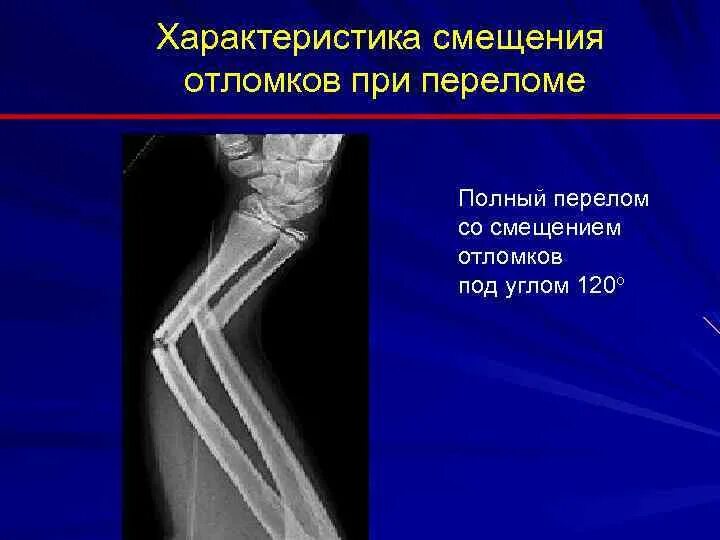 Вторичное смещение при переломе. Вторичное смещение при переломе