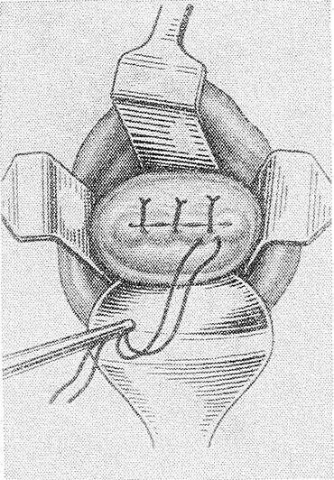 Наложение швов на шейку матки при беременности при ицн. Зашитая шейка матки при беременности. Зашитая шейка матки при беременности. Пластика шейки матки по ельцову стрелкову. Трансабдоминальный серкляж.