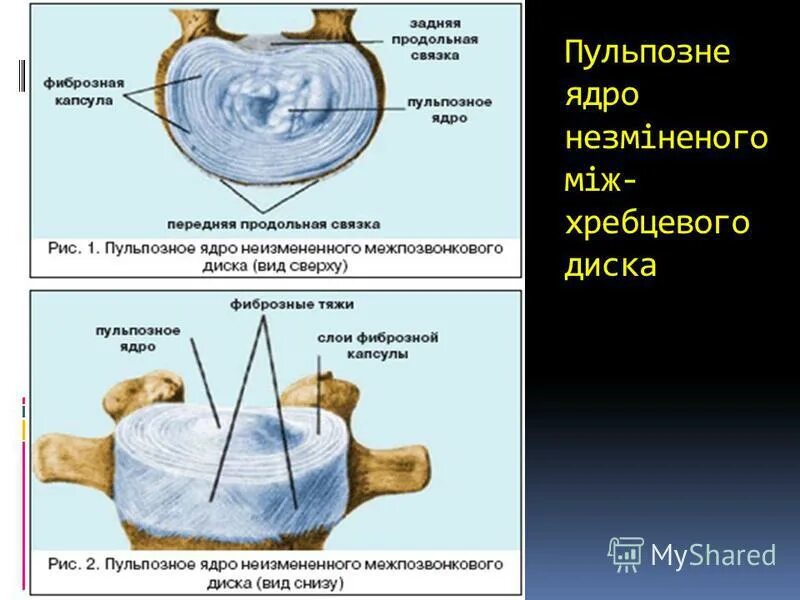 Содержимое межпозвоночного диска. Пульпозное ядро и фиброзное кольцо. Грыжа позвоночника пульпозное ядро. Пульпозное ядро межпозвоночного диска. Фиссура фиброзного кольца межпозвоночного диска что это.