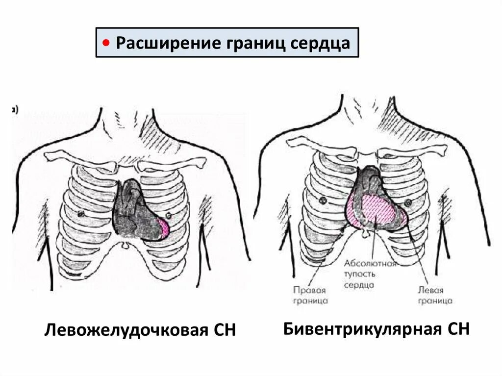 Границы расширены влево. Расширение границ сердца. Границы сердца расширены влево. Расширение абсолютной тупости сердца. Расширение относительной тупости сердца.