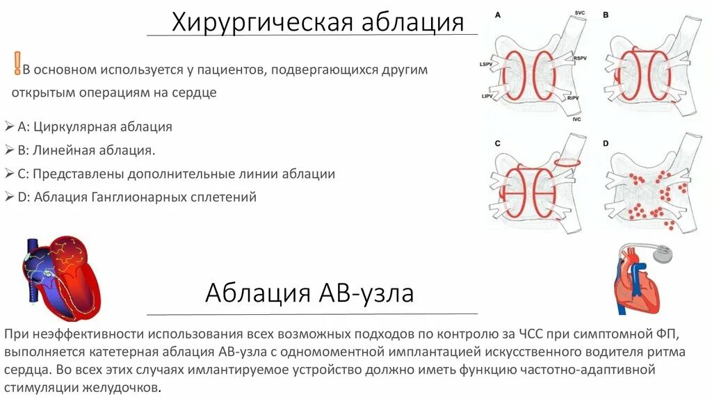 Рча предсердий. Радиочастотная абляция фибрилляции предсердий. Радиочастотная катетерная абляция. РЧА сердца при мерцательной аритмии. Радиочастотная катетерная абляция фибрилляции предсердий.