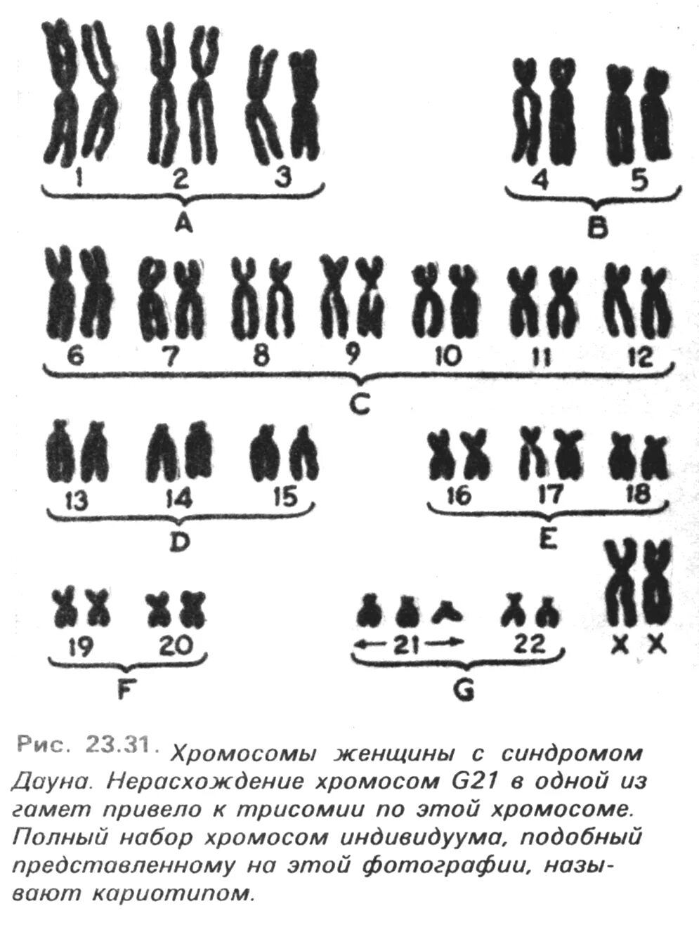 Сколько хромосом у людей с синдромом дауна. Синдром Дауна хромосомная карта. Синдром Дауна 21 хромосома. Синдром Дауна схема хромосом. Хромосомный набор человека с синдромом Дауна.