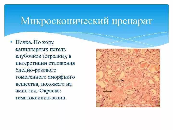 Амилоидоз сердца патанатомия. Амилоидоз почек гистология. Амилоидный нефроз патанатомия. Амилоидоз почек патанатомия. Амилоидоз почек патанатомия.