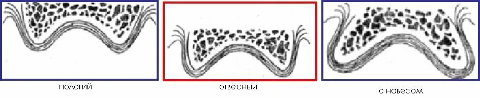 Атрофия альвеолярного отростка. Форма ската альвеолярного отростка. Форма вестибулярного ската альвеолярного отростка верхней челюсти. Альвеолярный гребень альвеолярного отростка. У кита альвеолярные легкие