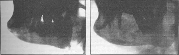 Язва луковицы 12 перстной кишки рентген. Язва луковицы 12 перстной кишки рентген. Хронический одонтогенный периостит. Симптом луковицы. Симптом луковицы.