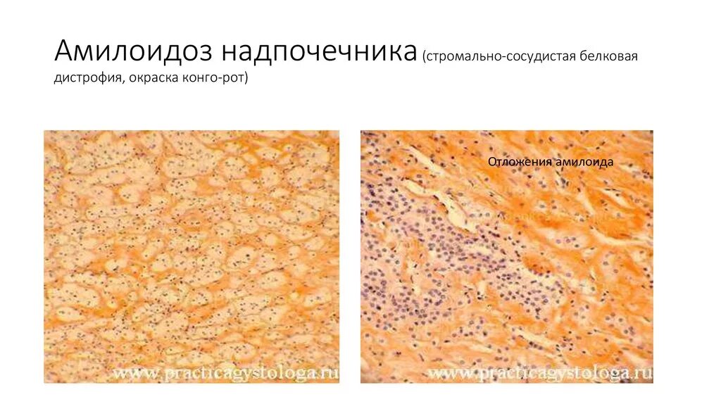 Дистрофия латынь. Стромальные дистрофии патанатомия. Амилоидоз надпочечников макропрепарат. Амилоидоз надпочечников микропрепарат Конго красный. Амилоидоз надпочечников препарат.