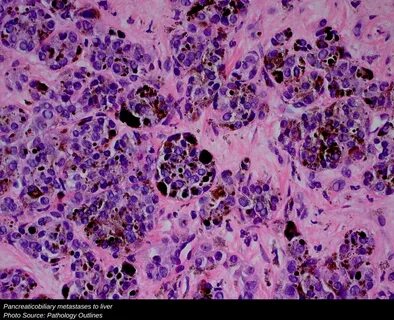 Metastasis