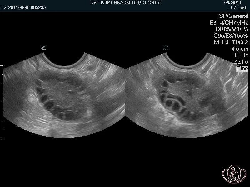 фолликулометрия узи доминантный фолликул. поликистозные яичники на узи. нормальные размеры яичников на узи. доминантный фолликул на узи. фолликулы в яичниках на узи норма.