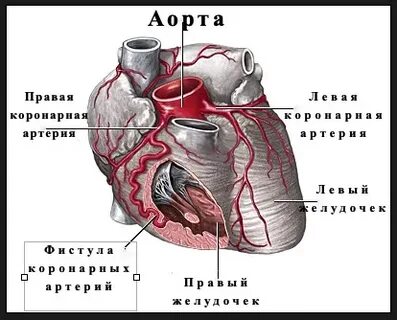 Коронарная фистула мкб