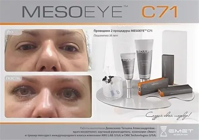 Мезоай цена. MESOEYE™ (МЕЗОАЙ). Биоревитализация МЕЗОАЙ. Мезо айс для глаз до и после. МЕЗОАЙ под глаза результат.