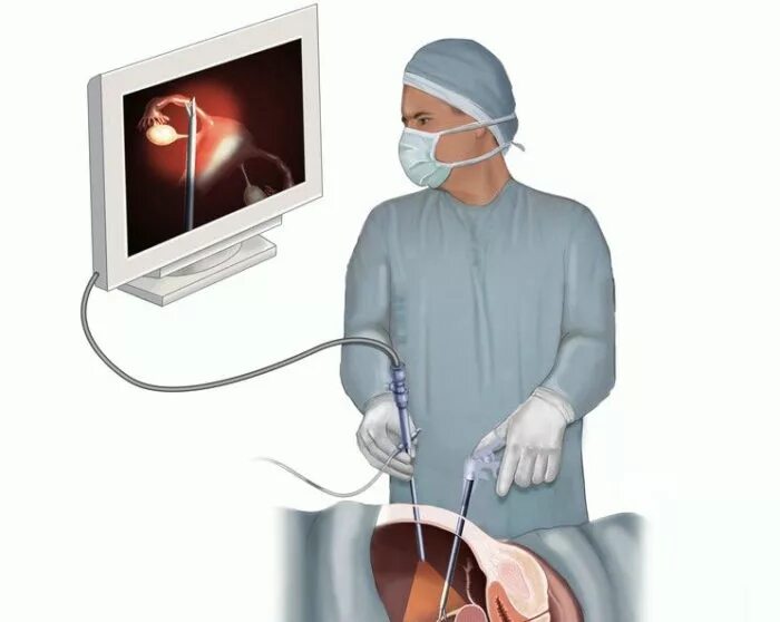 Лапароскопия миомы миомэктомия. Лапароскопия в торакальной хирургии. Лапароскопия брюшной полости. Лапароскопическая операция в гинекологии: подготовка к операции. Удаление матки гинеколог