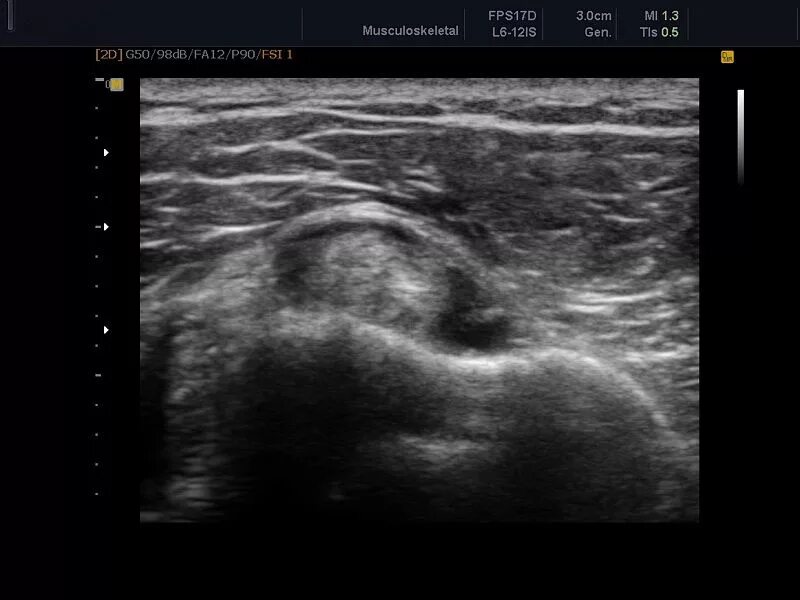 УЗИ мягких тканей (1 анатомическая зона). Образования мягких тканей голени на УЗИ. Организовавшаяся гематома мягких тканей на УЗИ. УЗИ поверхностных мягких тканей. Узи бабушкинская