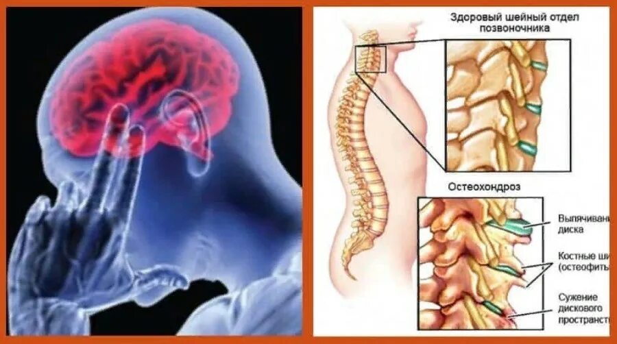 Улучшение кровообращения головного при шейном. Остеохондроз. Шейный отдел. Остеохондроз шейного отдела. Нарушения в шейном отделе позвоночника.